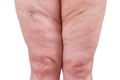 Varicose veins closeup, fat female legs isolated on white background Royalty Free Stock Photo