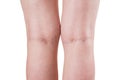 Varicose veins, female legs isolated on white background Royalty Free Stock Photo