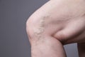 Varicose veins closeup. Thick female legs Royalty Free Stock Photo