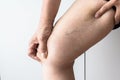 Varicose veins on the elderly asian woman leg,Close up Royalty Free Stock Photo