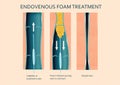 Varicose Veins. Endovenous foam Treatment. Structure of vein Royalty Free Stock Photo