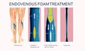 Varicose Veins. Endovenous foam Treatment. Structure of vein Royalty Free Stock Photo