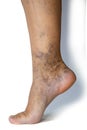 Varicose veins on a female legs. Phlebology problem. Woman`s health