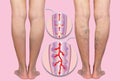 Varicose veins on a female senior legs. The structure of normal and varicose veins. Royalty Free Stock Photo