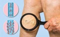 Varicose veins on a female senior legs. The structure of normal and varicose veins. Royalty Free Stock Photo