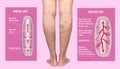 Varicose veins on a female senior legs. The structure of normal and varicose veins.