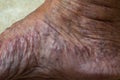 Varicose veins on foot in Senior women, Close up & Macro shot, Selective focus, Asian body skin part, Healthcare concept