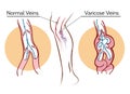 Varicose veins illustration