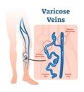 Varicose veins with irregular blood flow and healthy veins vector illustration diagram scheme.