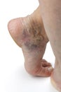 Varicose veins