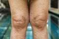 Varicose veins on knees and legs in Senior women, Asian Body skin part, Healthcare and beauty concept