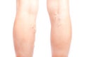 Varicose veins on the legs of a girl, phlebeurysm disease Royalty Free Stock Photo