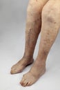 Pain syndrome and deformation of the foot with arthritis. Varicose veins in the legs.