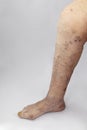 Pain syndrome and deformation of the foot with arthritis. Varicose veins in the legs. Royalty Free Stock Photo