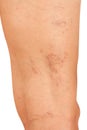 Varicose veins on the legs Royalty Free Stock Photo