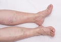 Varicose veins in the legs of a woman, white background, varicose veins on the calves of the legs and lower legs, phlebeurysm Royalty Free Stock Photo