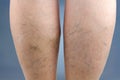 Varicose veins Royalty Free Stock Photo