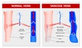 Varicose veins. Medical illustration