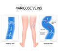 Varicose veins. Medical illustration