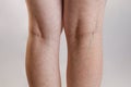 Varicose veins and medicine. Female legs close - up with vessels and the initial stage of varicose disease