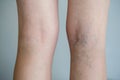 Varicose veins