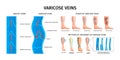 Varicose Veins Realistic Infographics