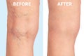 Varicose veins on the skin macro close up circulation problem medicine concept Royalty Free Stock Photo