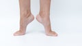 Varicose veins and spider veins on legs displayed in a clinical setting Royalty Free Stock Photo