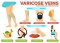 Varicose veins symptoms and preventions poster with info vector