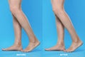 Before and after varicose veins treatment. Collage with photos of woman showing legs on light blue background, closeup