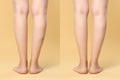 Before and after varicose veins treatment. Collage with photos of woman showing legs on yellow background, closeup