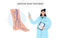 Varicose veins treatment