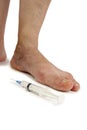 Varicose veins treatment