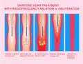 Varicose Veins and Treatment with radiofrequency ablation