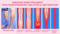 Varicose Veins and Treatment with radiofrequency ablation