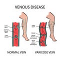 VARICOSE VEINS Venous Disease Of Human Medicine Education