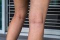 Varicose veins on the woman leg, Normal veins near the skin layer swell out, And blood is accumulated to see a bloody blue or dark Royalty Free Stock Photo