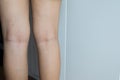 Varicose veins on the woman leg,Normal veins near the skin layer swell out,And blood is accumulated to see a bloody blue or dark Royalty Free Stock Photo