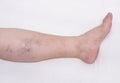 Varicose veins on a woman`s leg, white background, vascular pattern from varicose veins on the calf of the leg, phlebeurysm