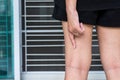 Varicose veins on the womans leg Royalty Free Stock Photo