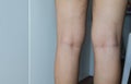 Varicose veins on the woman leg,Normal veins near the skin layer swell out,And blood is accumulated to see a bloody blue or dark