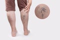 Varicosity. Close up view of old legs of woman with vascular asterisks. Zoomed area with blood vessels. White background