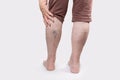 Varicosity and laser treatment. Close up of elderly legs of woman shows vascular asterisks. Rear view. Copy space. The