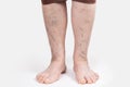 Varicosity and thrombosis. Close up of elderly feet of woman with vascular asterisks. White background. The concept of