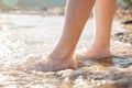 Varicosity. A woman stands on the beach in the water and shows a vascular mesh on the lower leg. Legs close-up. The beach is in