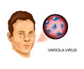 Variola virus. the defeat of the face Royalty Free Stock Photo