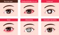 Various eye diseases vector illustration  female eye Royalty Free Stock Photo