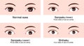 Various eye shapes different eyeball size and position vector illustration Classifications in Asia