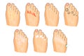 The various injuries of the feet. fungus, burning, warts, sweating. as well as soap, lotion, and spray Royalty Free Stock Photo