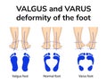 Varus and valgus deformity of the foot